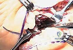 تحديد مكان الشق الجراحي في الكاحل