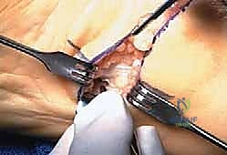 العلاجات التحفظية لالتهاب اللفافة الأخمصية