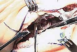 صورة توضيحية لـ علاج متلازمة النفق الرسغي واللفافة الأخمصية معًا: خبرة الأستاذ الدكتور محمد هطيف في صنعاء