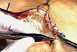 علاج متلازمة النفق الرسغي واللفافة الأخمصية معًا: خبرة الأستاذ الدكتور محمد هطيف في صنعاء