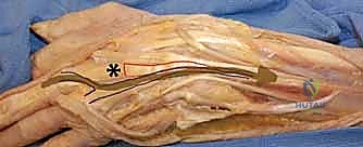 صورة توضيحية لـ إصلاح أوتار اليد الباسطة: دليل شامل لتعافي اليد والمعصم والساعد