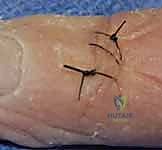 صورة توضيحية لـ إصلاح أوتار اليد الباسطة: دليل شامل لتعافي اليد والمعصم والساعد