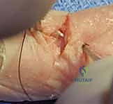 إصلاح أوتار اليد الباسطة: دليل شامل لتعافي اليد والمعصم والساعد