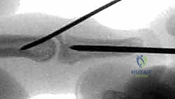 صورة توضيحية لـ إصلاح أوتار اليد الباسطة: دليل شامل لتعافي اليد والمعصم والساعد