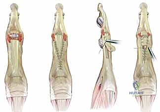 صورة توضح إصابة قطعية حادة في ظهر اليد