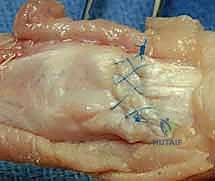 صورة توضيحية لـ إصلاح أوتار اليد الباسطة: دليل شامل لتعافي اليد والمعصم والساعد