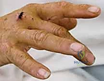 صورة توضيحية لـ إصلاح أوتار اليد الباسطة: دليل شامل لتعافي اليد والمعصم والساعد