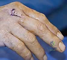 صورة توضيحية لـ إصلاح أوتار اليد الباسطة: دليل شامل لتعافي اليد والمعصم والساعد