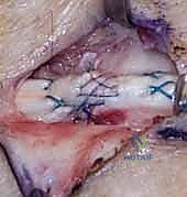 صورة طبية: إصلاح أوتار اليد الباسطة: دليل شامل لتعافي اليد والمعصم والساعد