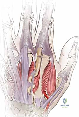 صورة طبية: إصلاح أوتار اليد الباسطة: دليل شامل لتعافي اليد والمعصم والساعد
