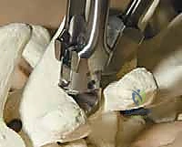 صورة طبية: تصحيح الجنف بالخطاطيف والأوتاد الفقرية: دليل شامل للمرضى مع الأستاذ الدكتور محمد هطيف