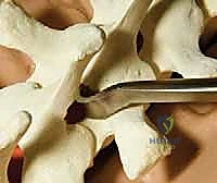 صورة توضيحية لـ تصحيح الجنف بالخطاطيف والأوتاد الفقرية: دليل شامل للمرضى مع الأستاذ الدكتور محمد هطيف