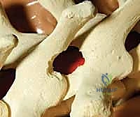 صورة توضيحية لـ تصحيح الجنف بالخطاطيف والأوتاد الفقرية: دليل شامل للمرضى مع الأستاذ الدكتور محمد هطيف