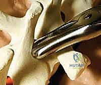 صورة توضيحية لـ تصحيح الجنف بالخطاطيف والأوتاد الفقرية: دليل شامل للمرضى مع الأستاذ الدكتور محمد هطيف