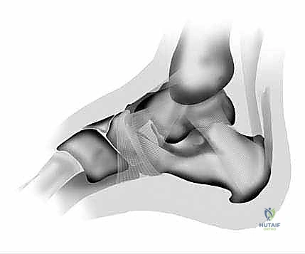 بضع اللفافة الأخمصية بالمنظار: حل ثوري لآلام الكعب المزمنة في صنعاء مع الأستاذ الدكتور محمد هطيف