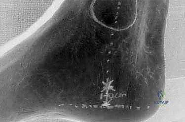 إدخال الأدوات الدقيقة والمنظار عبر الشقوق الصغيرة