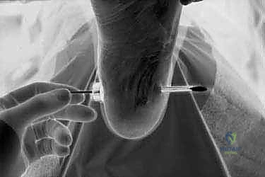 التشريح الدقيق لللفافة الأخمصية وعلاقتها بآلام الكعب