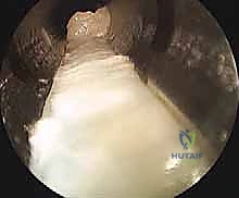 تقييم الحالة وتحديد موقع الألم قبل الجراحة