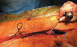 Illustration of kyphectomy in spina - Dr. Mohammed Hutaif