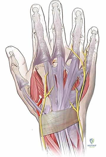 Extensor Tendon Reconstruction: A Masterclass in Tendon Transfer and Grafting