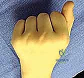 تقنيات إعادة بناء الرباط السهمي المتقدمة