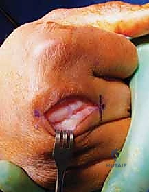 تصنيف درجات خلع وتر الباسطة