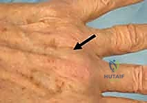 صورة توضيحية لـ خلع وتر الباسطة في اليد: دليل شامل لإصلاح وإعادة بناء الرباط السهمي مع الأستاذ الدكتور محمد هطيف