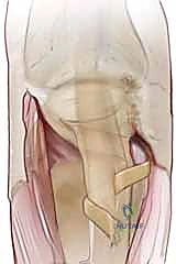 صورة طبية: خلع وتر الباسطة في اليد: دليل شامل لإصلاح وإعادة بناء الرباط السهمي مع الأستاذ الدكتور محمد هطيف
