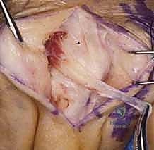 صورة طبية: خلع وتر الباسطة في اليد: دليل شامل لإصلاح وإعادة بناء الرباط السهمي مع الأستاذ الدكتور محمد هطيف