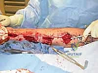 Neuroma Transection and Proximal Burial in the Foot and Ankle: An Intraoperative Masterclass