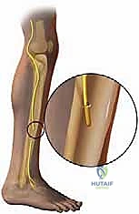 TECH FIG 6 Drilling unicortical hole in fibula for transected superior peroneal nerve ending