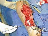 TECH FIG 6 Drilling unicortical hole in fibula for transected superior peroneal nerve ending