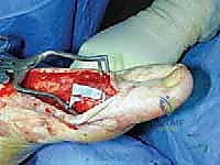 TECH FIG 9 Saphenous nerve neuroma and small anterior branch