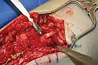 TECH FIG 9 Saphenous nerve neuroma and small anterior branch