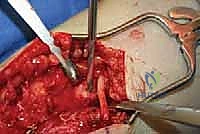 TECH FIG 9 Saphenous nerve neuroma and small anterior branch