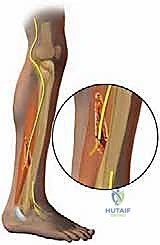 TECH FIG 6 Drilling unicortical hole in fibula for transected superior peroneal nerve ending