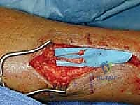 TECH FIG 9 Saphenous nerve neuroma and small anterior branch