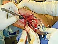 FIG 4 Simple bulb neuroma after sural nerve resection