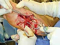 TECH FIG 10 Dissection of the medial plantar nerve and branches