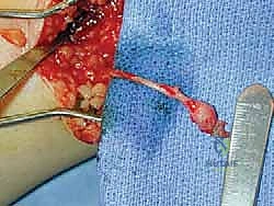 FIG 4 Simple bulb neuroma after sural nerve resection