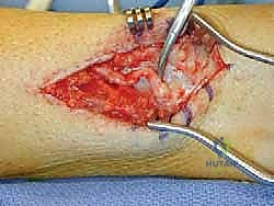 FIG 5 Previous burial of superior peroneal nerve into bone with mild neuritis and small more proximal branch