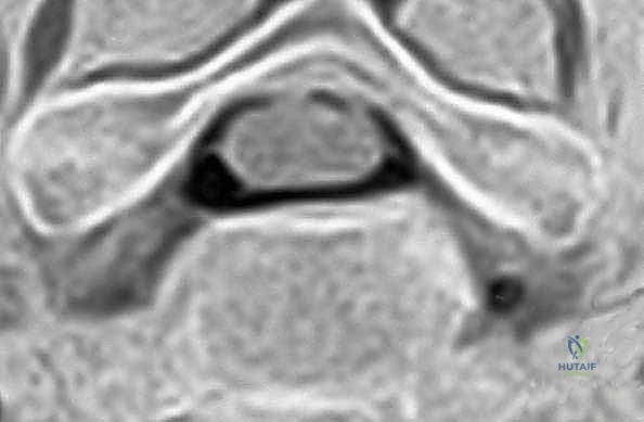 تآكل الغضاريف العنقية