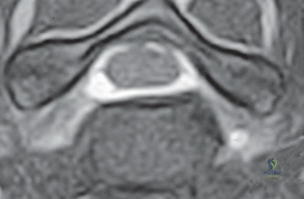 صورة شعاعية للفقرات العنقية