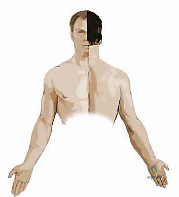 النتوءات العظمية في الرقبة