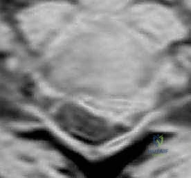 العلاج الطبيعي للرقبة