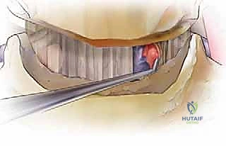 صورة توضيحية لـ عملية استئصال القرص العنقي الأمامي ودمج الفقرات (ACDF) دليل شامل من الأستاذ الدكتور محمد هطيف