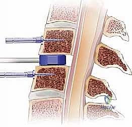 صورة توضيحية لـ عملية استئصال القرص العنقي الأمامي ودمج الفقرات (ACDF) دليل شامل من الأستاذ الدكتور محمد هطيف