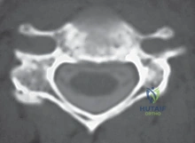 صورة طبية: عملية استئصال القرص العنقي الأمامي ودمج الفقرات (ACDF) دليل شامل من الأستاذ الدكتور محمد هطيف