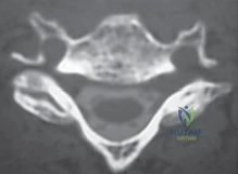 توضيح الانزلاق الغضروفي