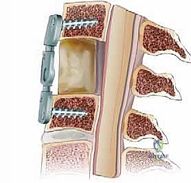 صورة توضيحية لـ عملية استئصال القرص العنقي الأمامي ودمج الفقرات (ACDF) دليل شامل من الأستاذ الدكتور محمد هطيف